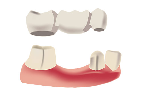 dental-bridge-vancouver Dentist Vancouver Dental Bridges