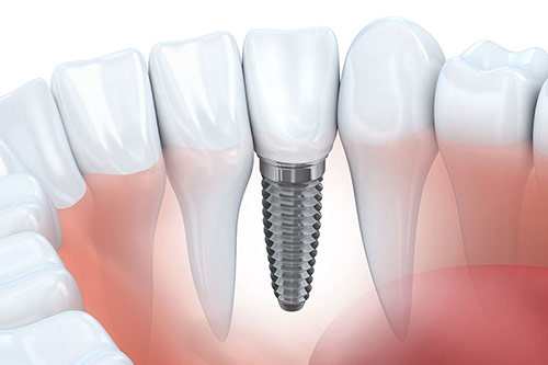 dental-implant-vancouver Fraser Street Dentist Dental Implant