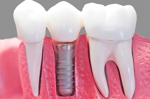 dental-implants-vs-bridges-vancouver Dentist Vancouver dental implants vs bridges vancouver