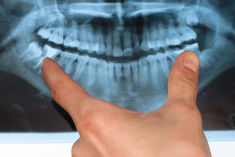 panoramic-xray-vancouver Panoramic Xray Fraser Street Dentist Vancouver